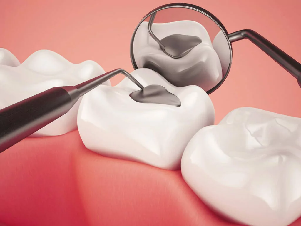 How Long Should A Dental Filling Last?