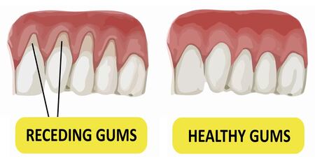 Receding Gum treatment: causes & surgery