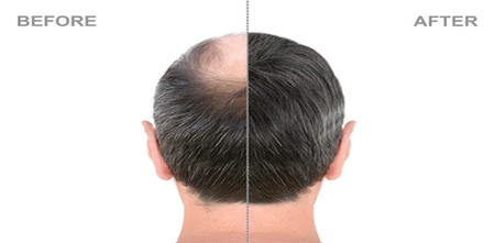 Can hair transplantation be helpful for women experiencing hair loss?