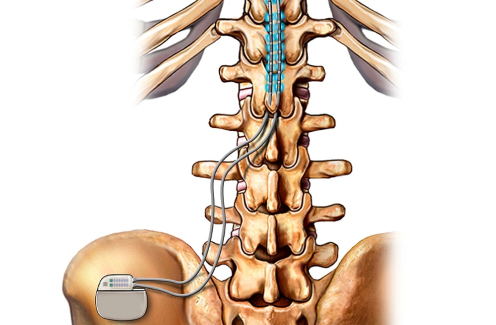 Spinal cord stimulation in pain management
