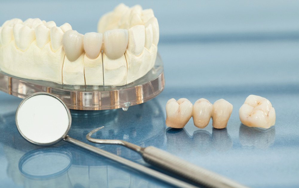 What Is the Best Option for Replacing Missing Teeth Treatment?