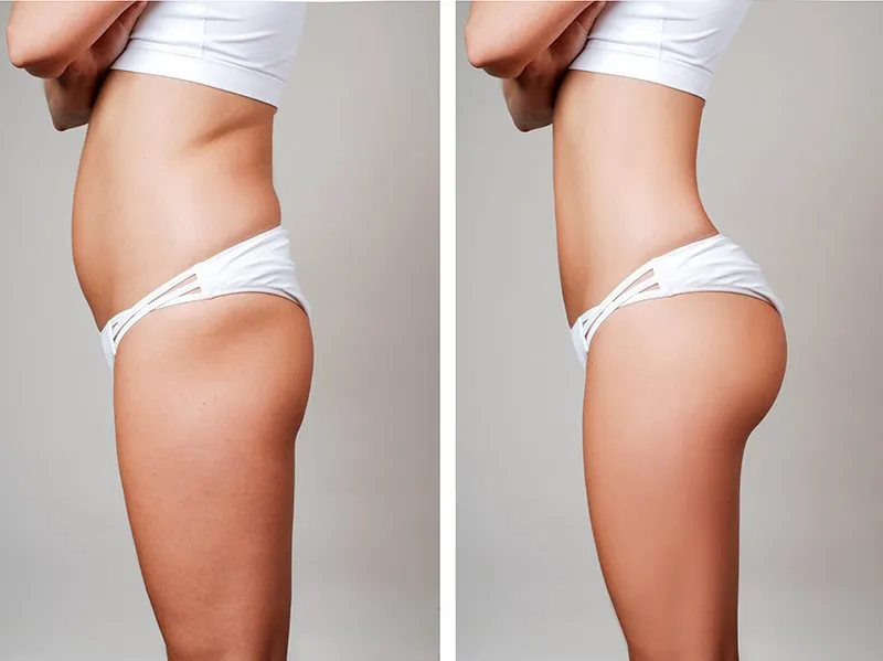 Liposuction Colombia cost: Why Should you Get the Treatment
