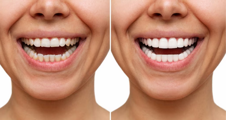 Dental Bonding: A Quick and Easy Way to Improve Your Smile!