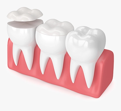 Improve Your Cracked Tooth Through Dental Crown Services
