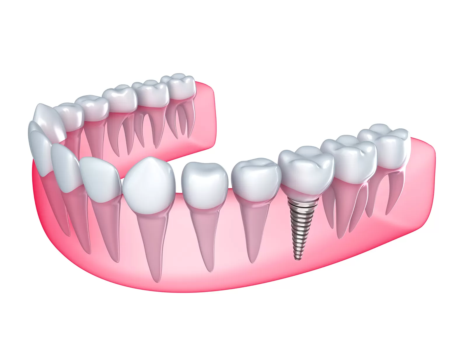 A Dental Implant Is A Teeth Root Replacement