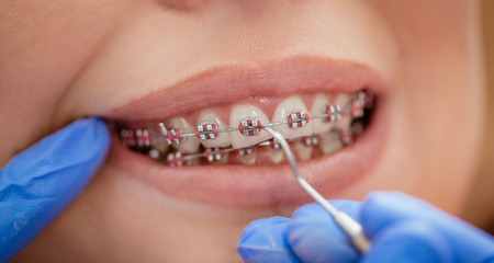 Invisalign Vs Braces: Making the Right Choice for Your Teeth