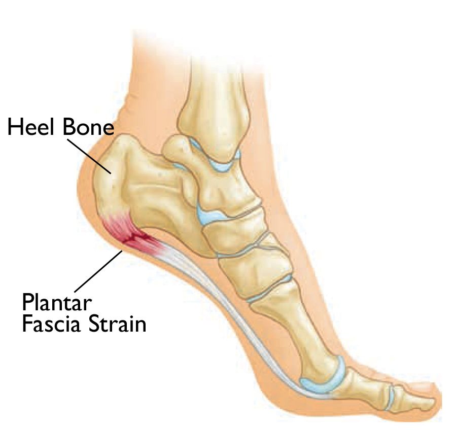 The Role of Orthotics in Heel Pain Management