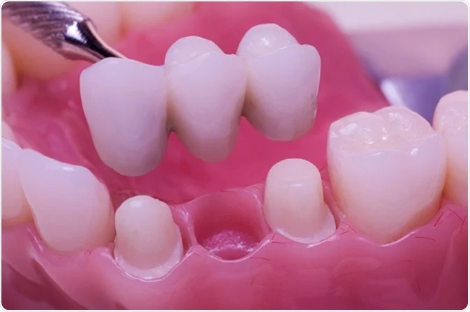 Comprehensive Guide To Dental Bridges: Restoring Your Smile