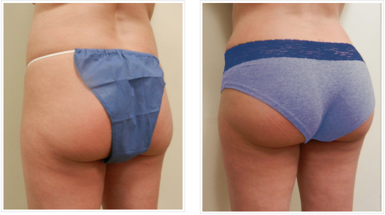 A comprehensive look at the trends and health implications of butt injections: