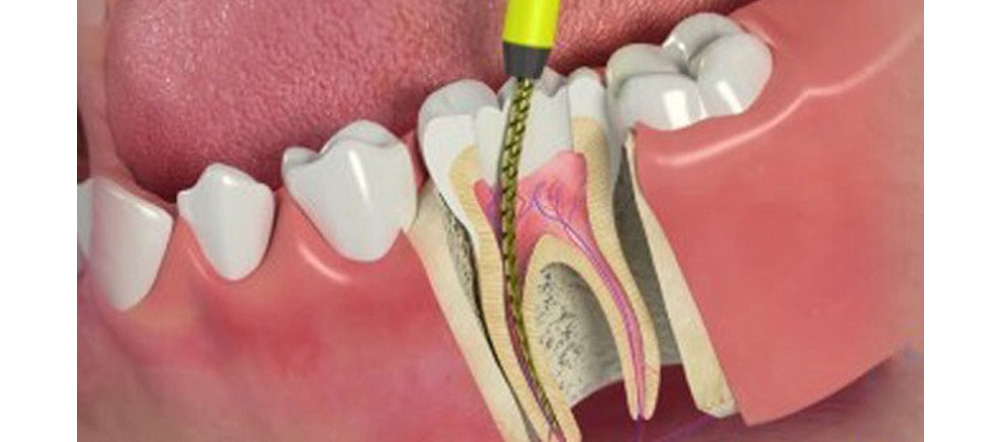 How to Ease Post-Root Canal Treatment Discomfort