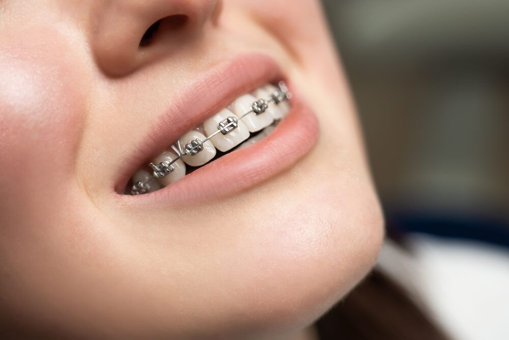 Best Dental Braces Treatment
