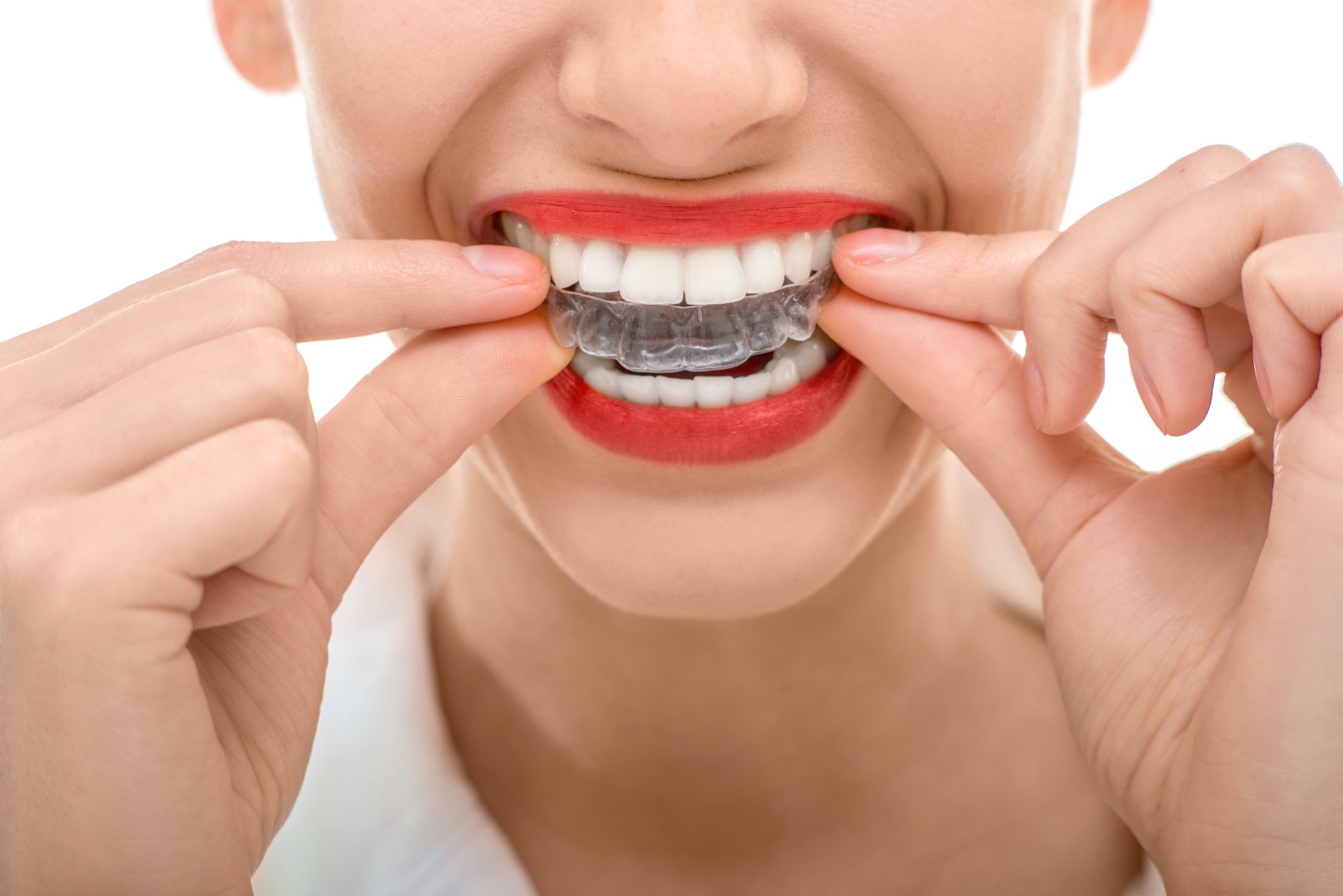 Unveiling the Magic: How Does Invisalign Work?