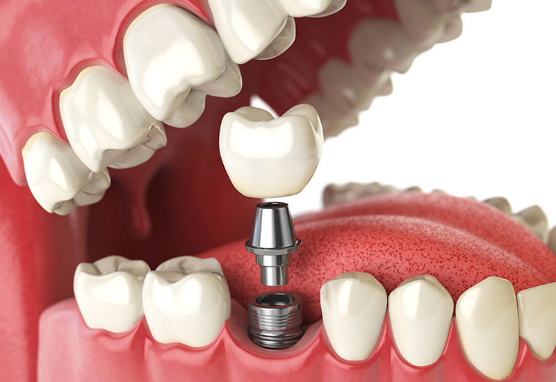 Debunking Common Myths and Misconceptions About Dental Implants