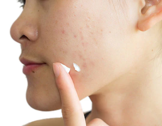 Comprehensive Guide: How Cleansing Oils Help Control Acne Breakouts?