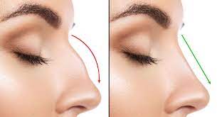 Thread Sculpt: Non-Surgical Rhinoplasty Unveiled in the Heart of Dubai