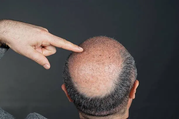 The Pinnacle of Hair Transplantation: The Numerous Benefits of Follicular Unit Extraction (FUE)