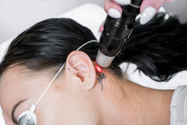 Uninking the Canvas: Laser Technology in Tattoo Removal