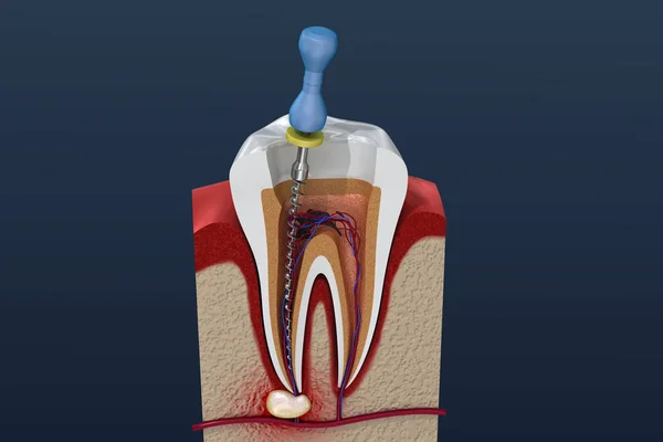 Root Canal Complications: Risks and Prevention