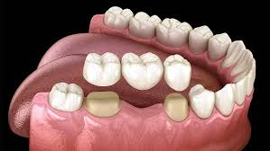 Dental Crowns treatment