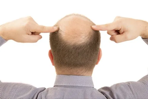 The Impact of Weather and Climate on Hair Transplant Recovery