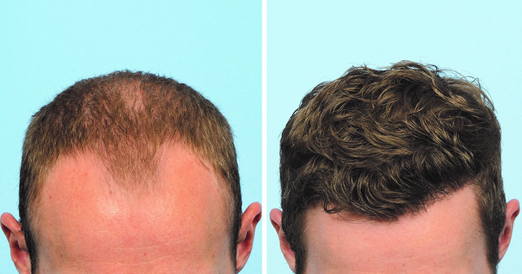 How do surgeons determine the appropriate hairline design for a patient?
