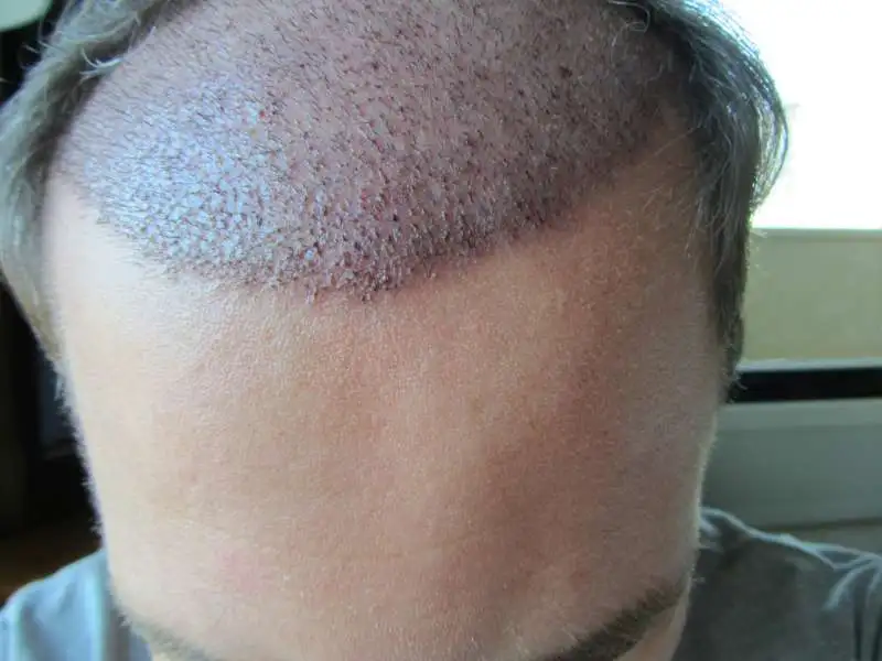 Can medications like finasteride and minoxidil prevent further hair loss after a transplant?