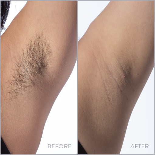 Reasons Behind Laser Hair Removal is the Best Choice to Get Rid of Unwanted Hair