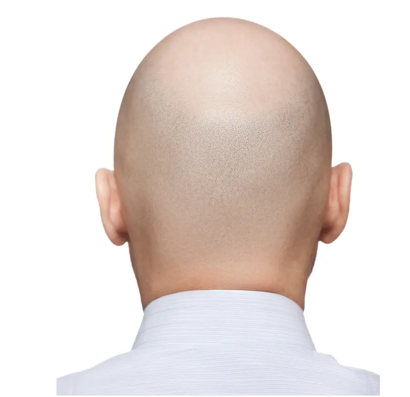 How prevalent is Alopecia Areata in Dubai?
