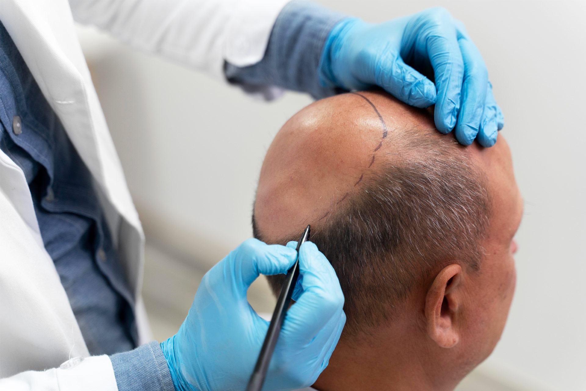 Hair Transplant in Dubai: Restoring Your Youthful Appearance