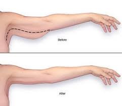 Affordable arm lift surgery Abu Dhabi
