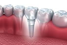 Affordable Dental Implant Financing Options