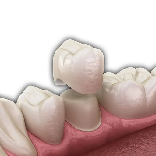 The Ultimate Guide to Dental Crowns in Denver: Finding Quality and Comfort