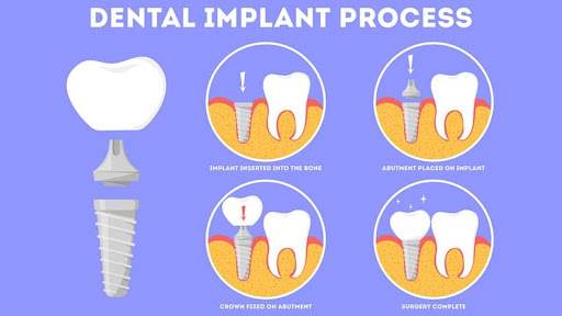 Dental Implants Washington DC
