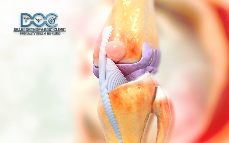 Total Knee Replacement vs. Partial Knee Replacement: Understanding the Differences