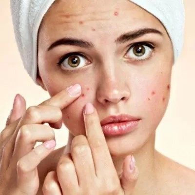 Over-the-Counter vs. Prescription Acne Medications: What Works Best in Abu Dhabi?