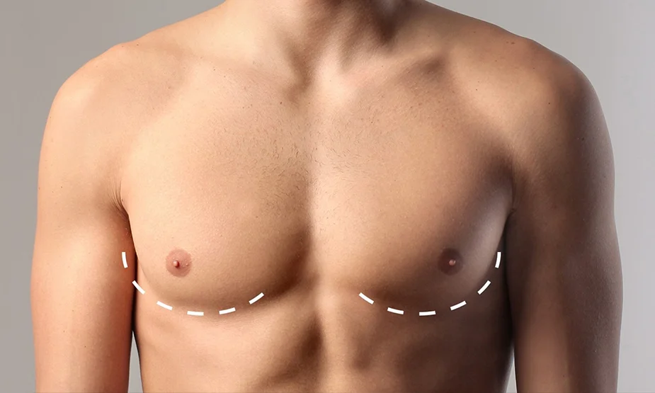 Gynecomastia Surgery in Chandigarh: Your Path to Confidence