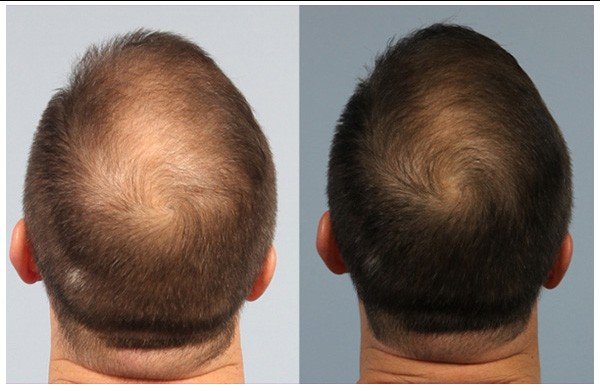 PRP Hair Treatment and its Impact on DHT (Dihydrotestosterone)