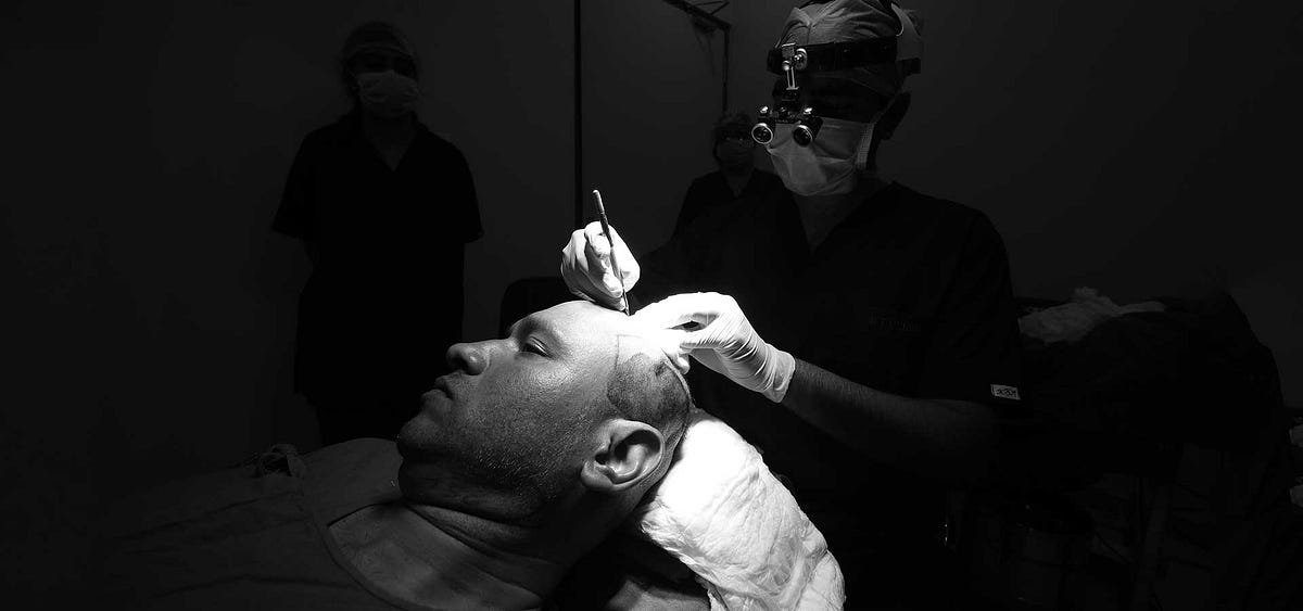 The Interlinking FUE Technique: A Revolution in Hair Transplant Treatment